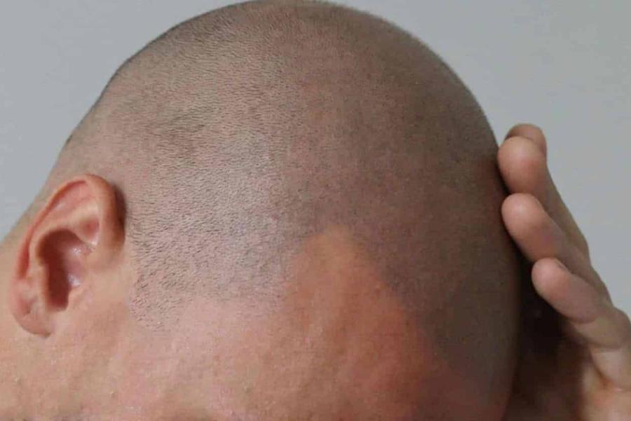 A man's scalp with new grown hairs on bald scalp