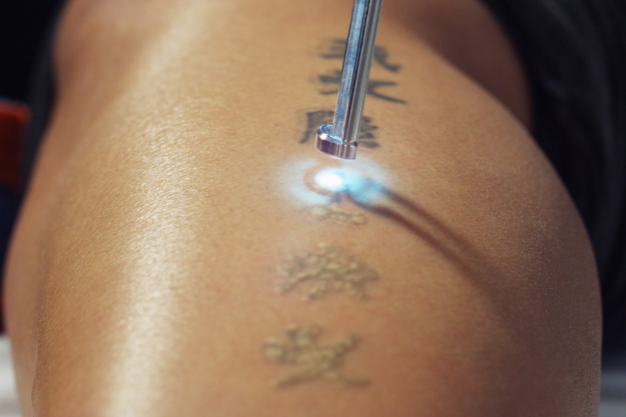 A tattoo being removed with laser