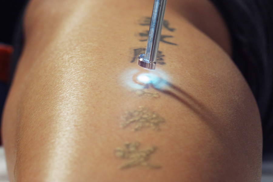 How laser hair removal affects tattoos