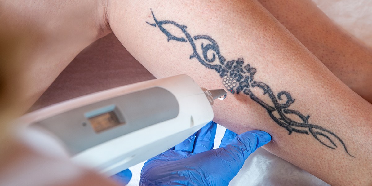 does tattoo removal hurt more than tattoo reddit