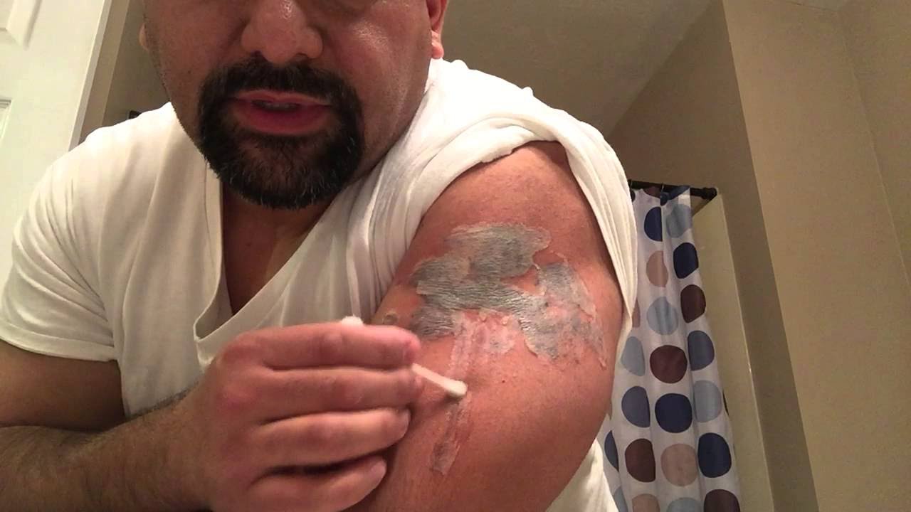 FDA Tattoo removal no simple process  CBS News