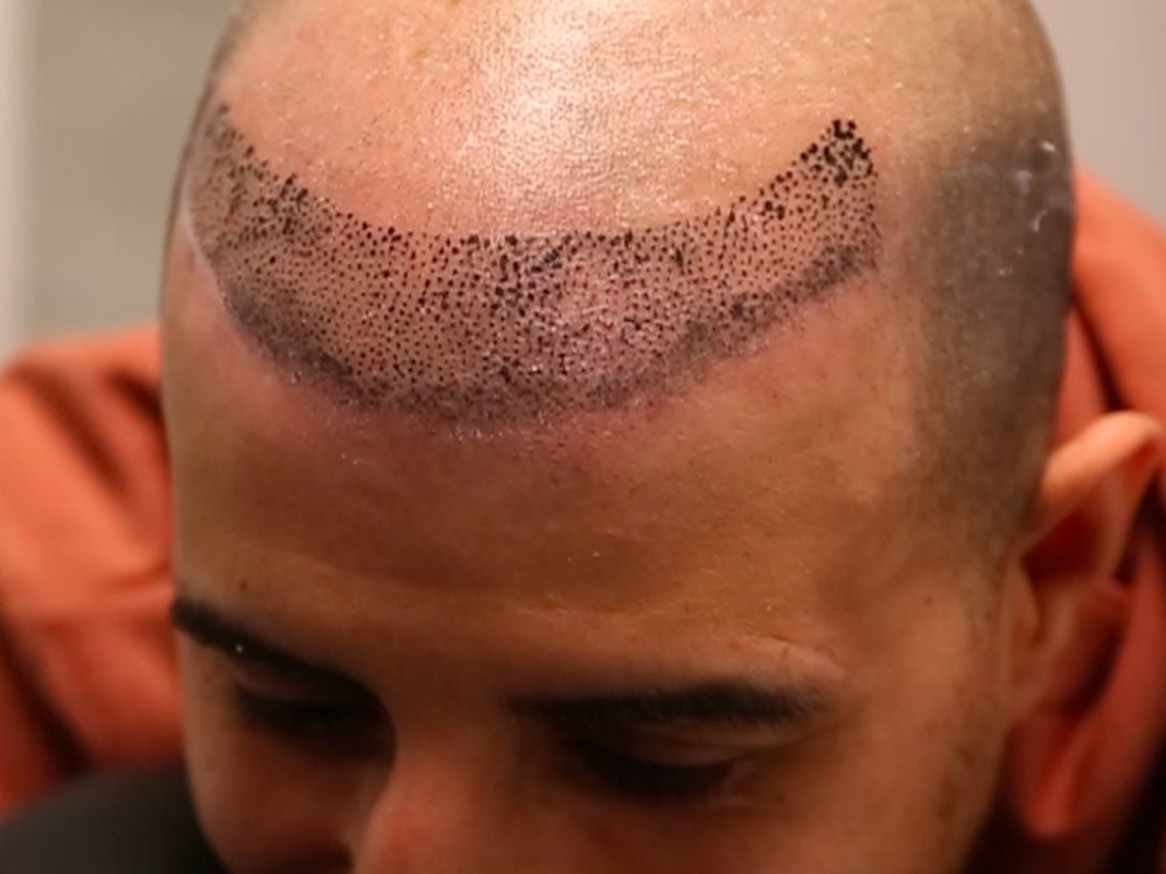 A Guide to Hairline Tattoos Man of Many