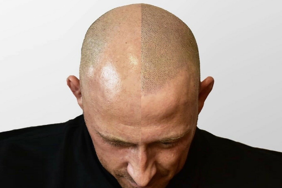 Share 81 Hair Tattoo For Bald Guys Latest Esthdonghoadian