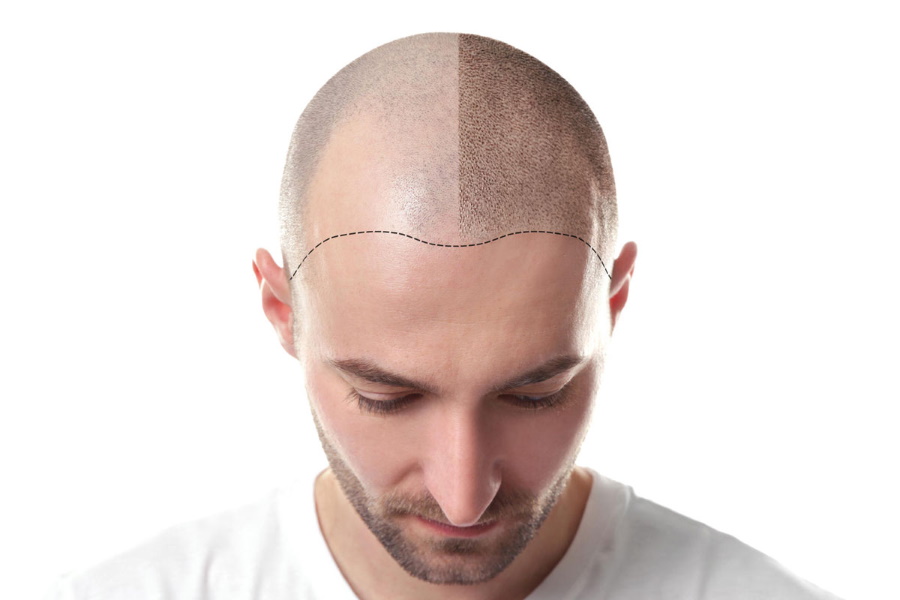 A Guide to Hairline Tattoos