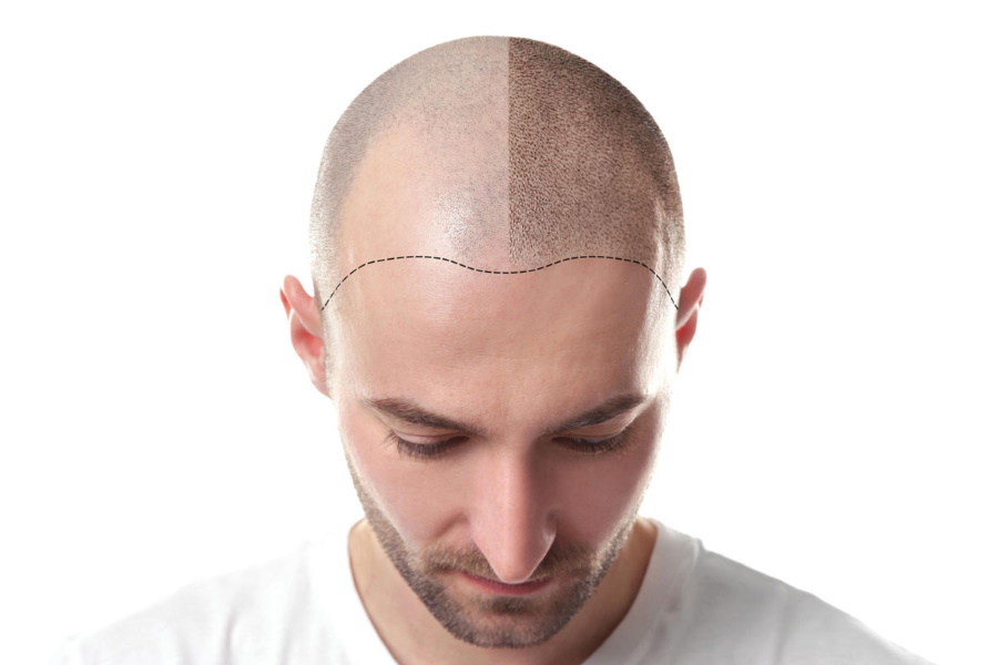 Scalp tattoos an interesting way to empower men with hairloss