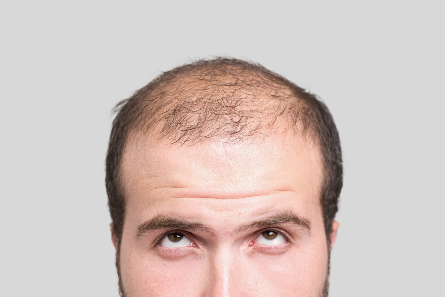 Quick Facts: Hair Loss - MSD Manual Consumer Version