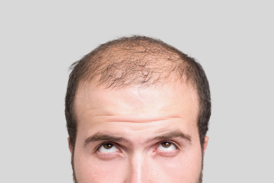 What Are The Main Causes Of Hair Loss In Children