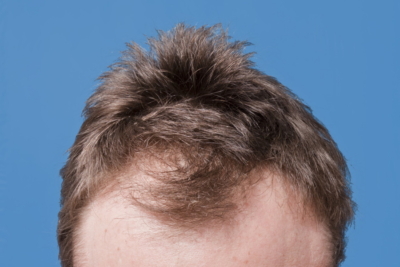 6 Common Hair Loss Causes in Men