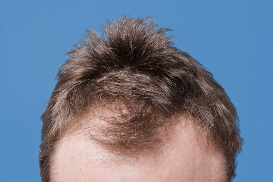 A hair-loss suffering man's head with baldness in front