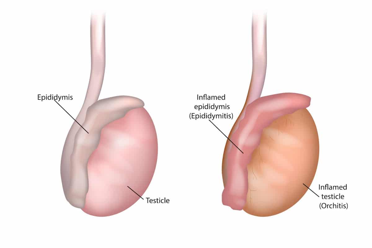 Epididymal hypertension