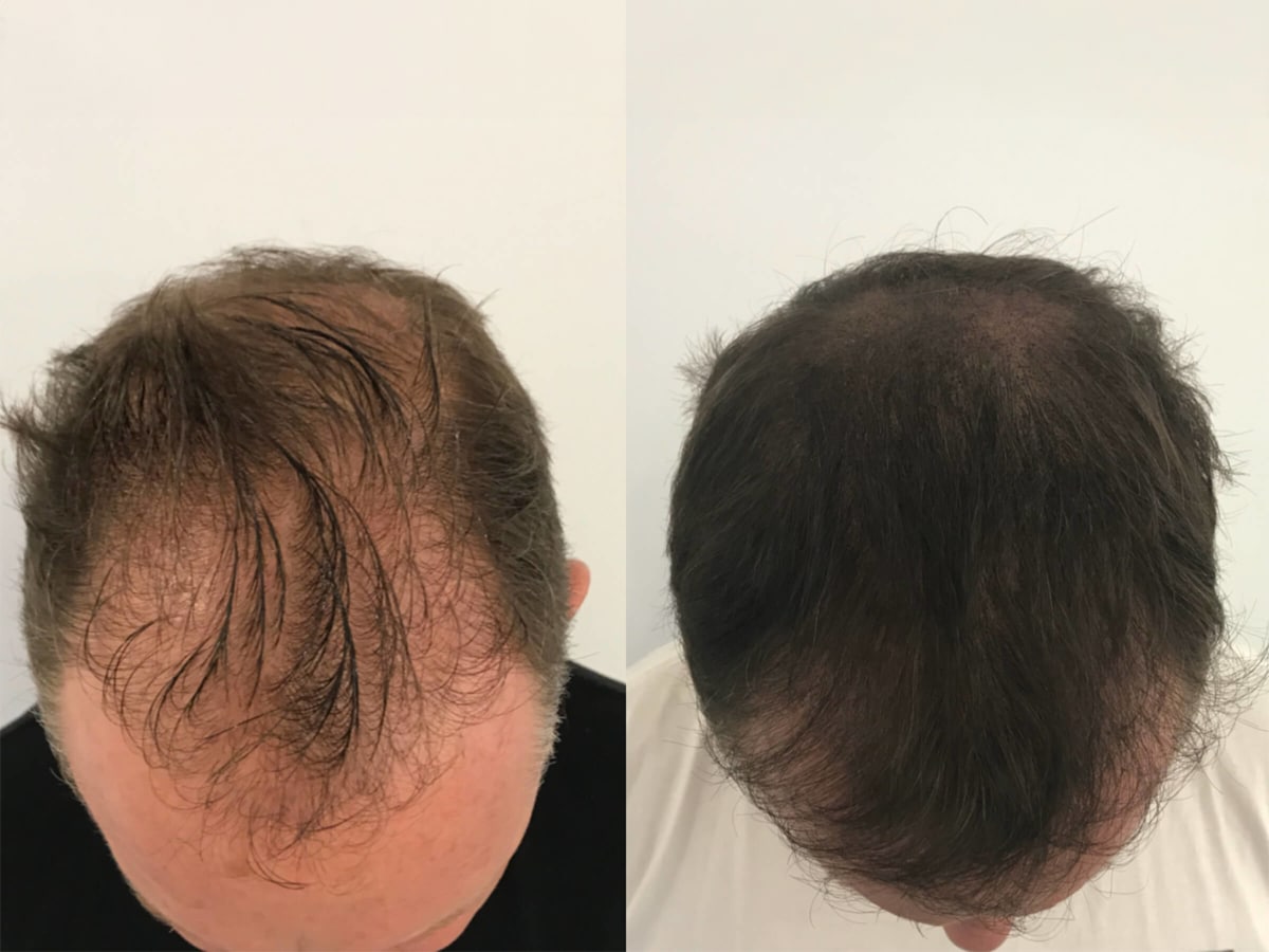 Scalp of a man with hair loss and one full of hair